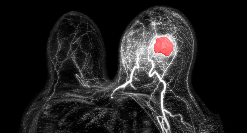 Quibim Introduces CE-Marked Tool to Detect Breast Cancer Through MRI